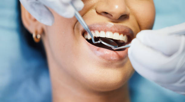 Best Chipped Tooth Repair Near Me  in Hartley, IA